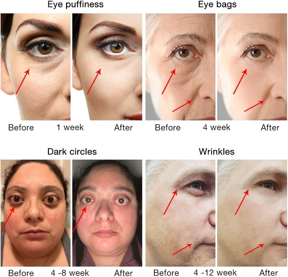 Eye Beauty Instrument, eye RF Anti Aging uređaj | torbe za oči | natečenost | tamni krugovi / Vranine noge