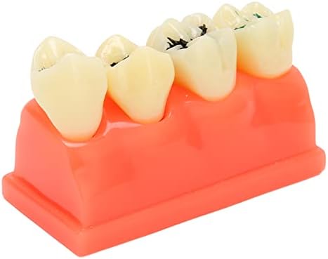 Slomljeni model zuba Model Propadanje modela obrazovne strukture za stomatološku bolnica za vašu demonstraciju